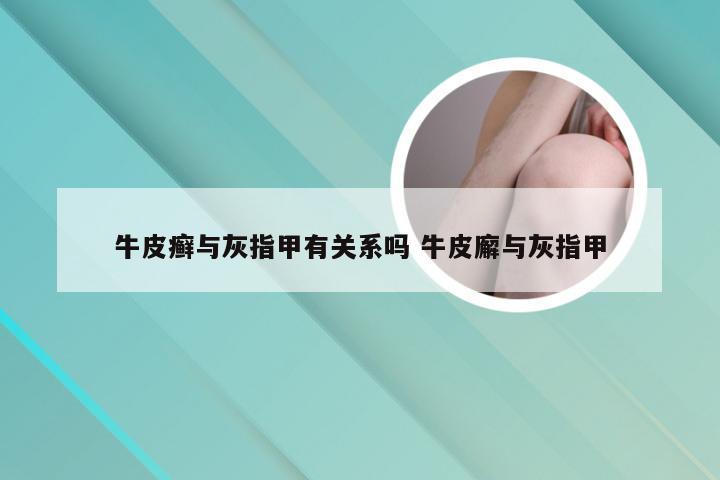 牛皮癣与灰指甲有关系吗 牛皮廨与灰指甲