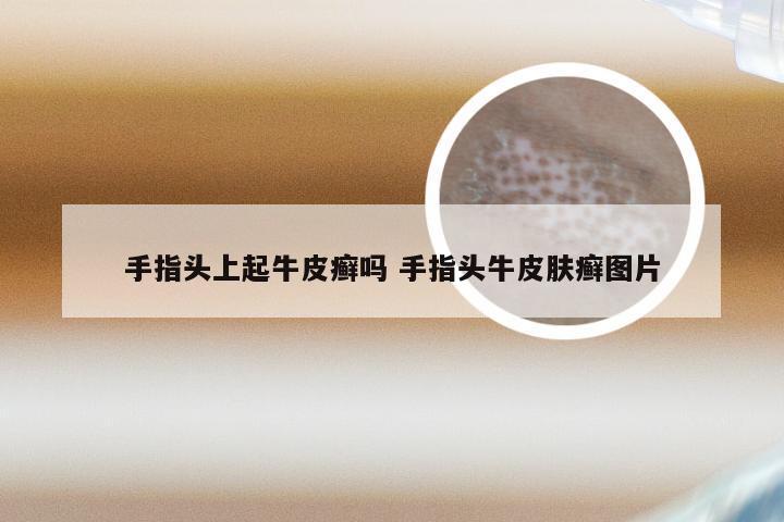 手指头上起牛皮癣吗 手指头牛皮肤癣图片