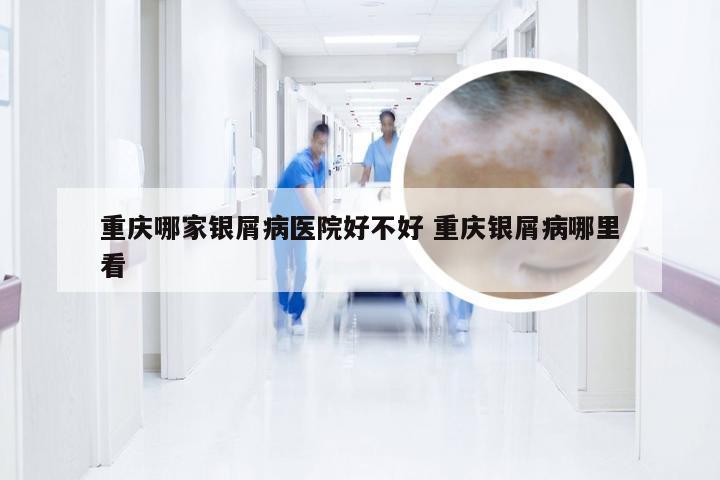 重庆哪家银屑病医院好不好 重庆银屑病哪里看