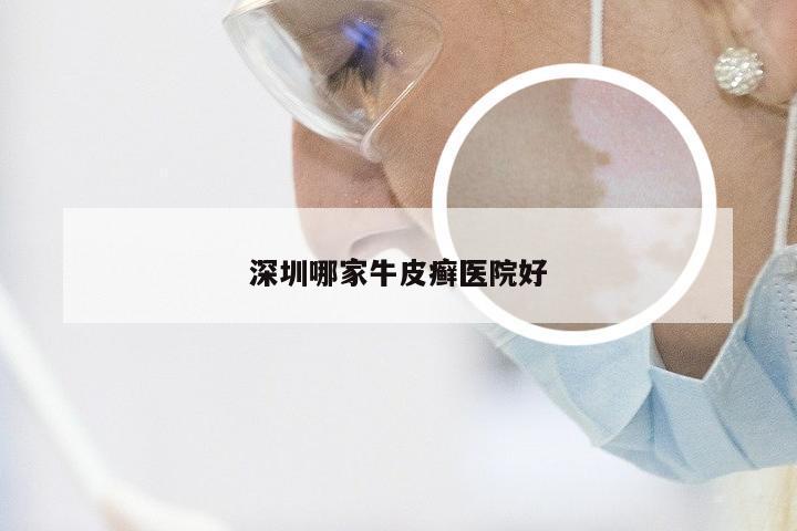 深圳哪家牛皮癣医院好