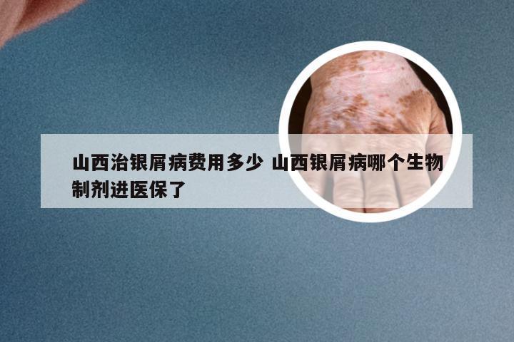山西治银屑病费用多少 山西银屑病哪个生物制剂进医保了