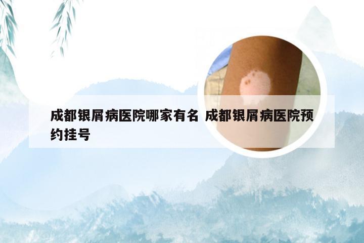 成都银屑病医院哪家有名 成都银屑病医院预约挂号