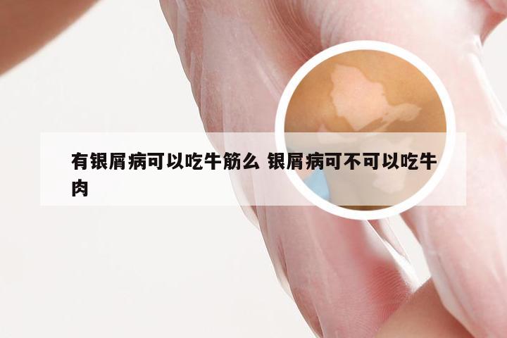 有银屑病可以吃牛筋么 银屑病可不可以吃牛肉