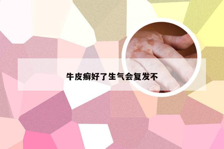 牛皮癣好了生气会复发不