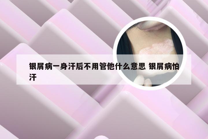 银屑病一身汗后不用管他什么意思 银屑病怕汗
