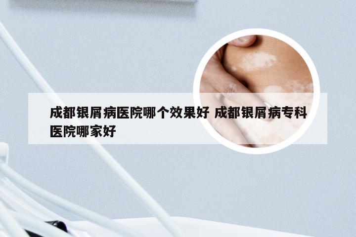 成都银屑病医院哪个效果好 成都银屑病专科医院哪家好