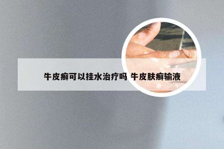 牛皮癣可以挂水治疗吗 牛皮肤癣输液