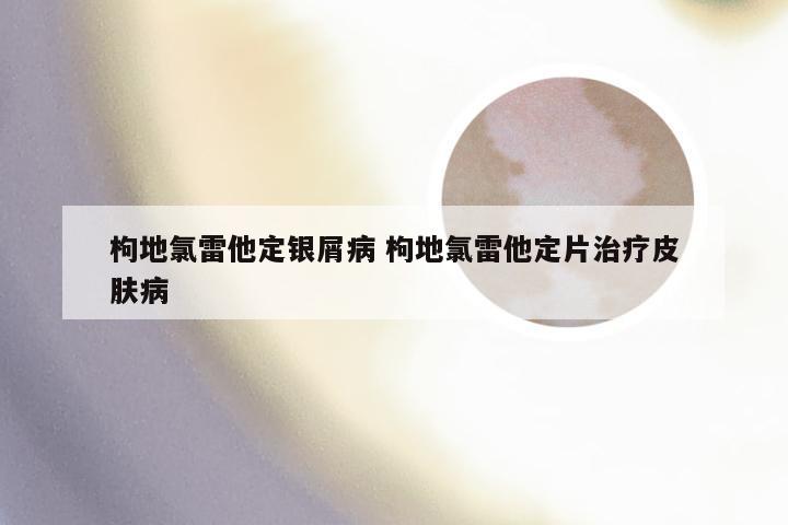 枸地氯雷他定银屑病 枸地氯雷他定片治疗皮肤病