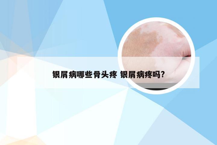 银屑病哪些骨头疼 银屑病疼吗?