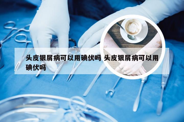 头皮银屑病可以用碘伏吗 头皮银屑病可以用碘伏吗