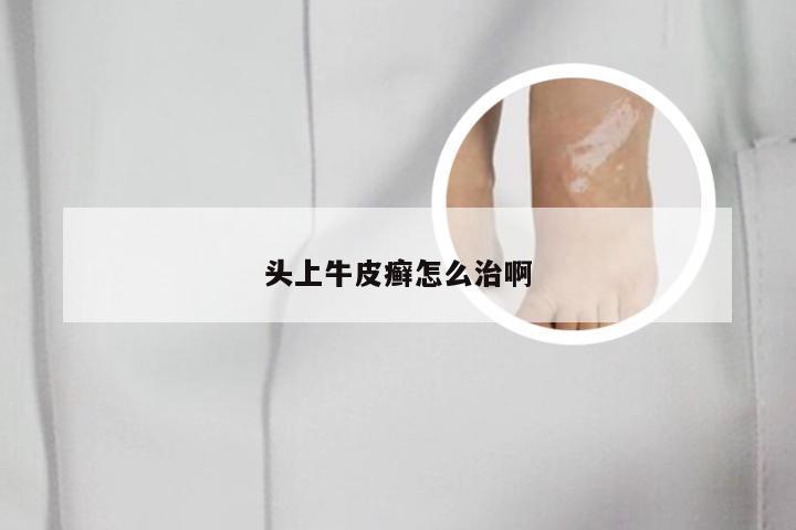 头上牛皮癣怎么治啊