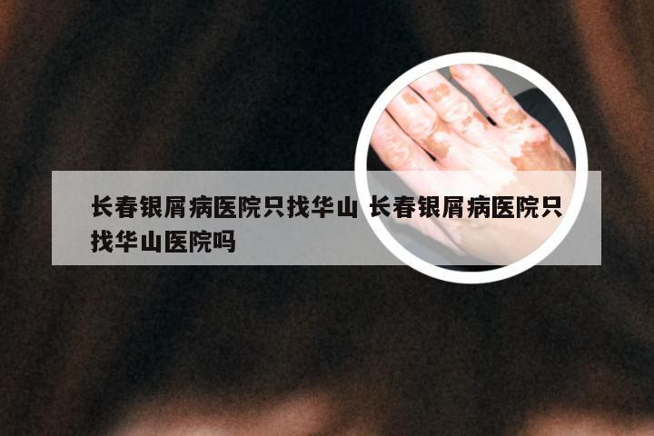 长春银屑病医院只找华山 长春银屑病医院只找华山医院吗