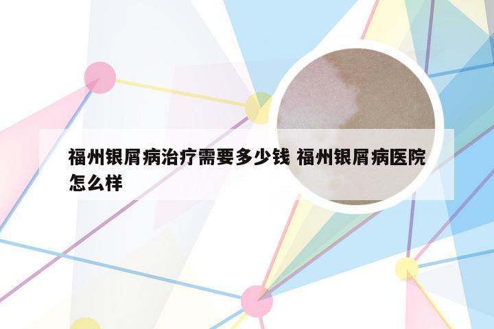 福州银屑病治疗需要多少钱 福州银屑病医院怎么样