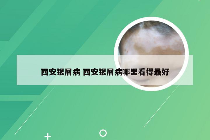 西安银屑病 西安银屑病哪里看得最好