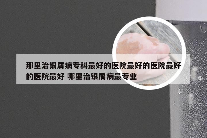 那里治银屑病专科最好的医院最好的医院最好的医院最好 哪里治银屑病最专业