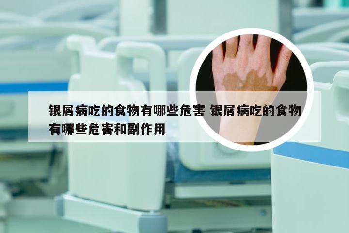 银屑病吃的食物有哪些危害 银屑病吃的食物有哪些危害和副作用