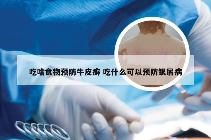 吃啥食物预防牛皮癣 吃什么可以预防银屑病