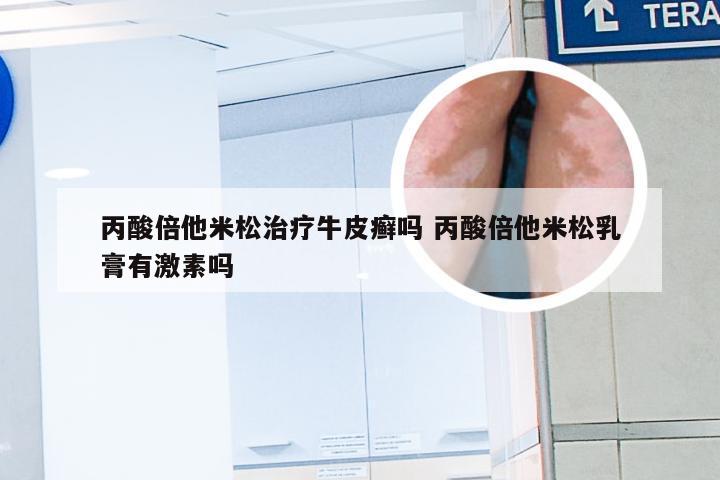 丙酸倍他米松治疗牛皮癣吗 丙酸倍他米松乳膏有激素吗