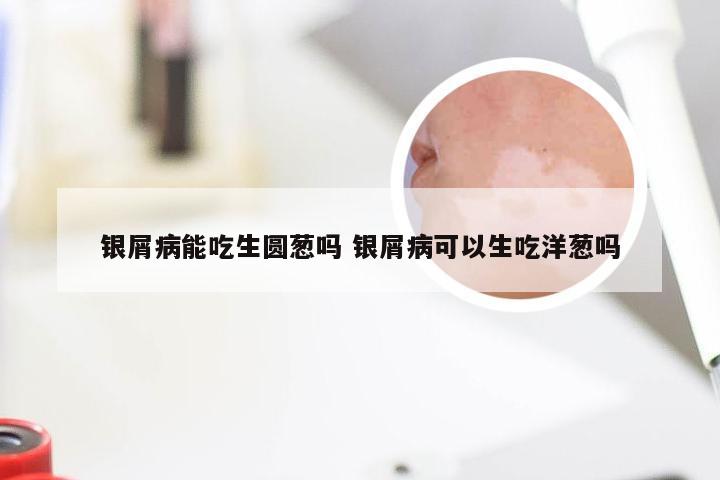 银屑病能吃生圆葱吗 银屑病可以生吃洋葱吗