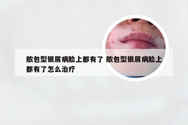 脓包型银屑病脸上都有了 脓包型银屑病脸上都有了怎么治疗
