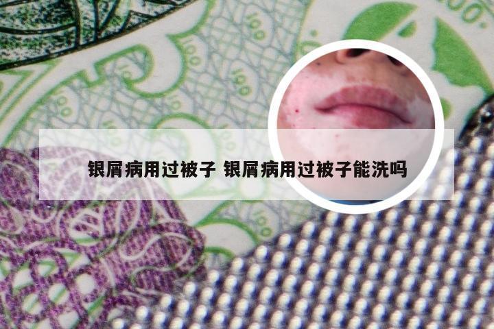 银屑病用过被子 银屑病用过被子能洗吗