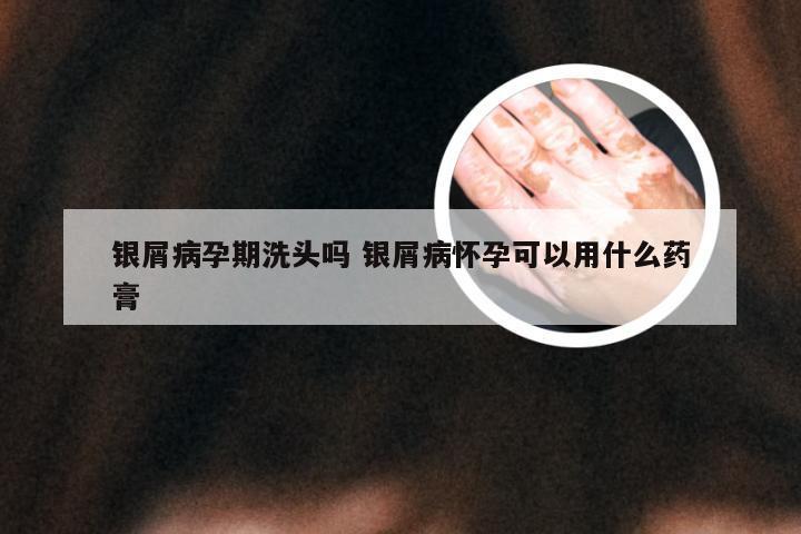 银屑病孕期洗头吗 银屑病怀孕可以用什么药膏