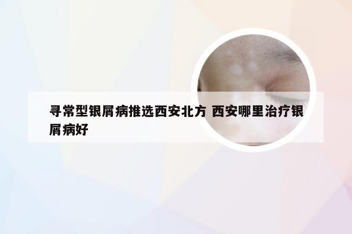 寻常型银屑病推选西安北方 西安哪里治疗银屑病好