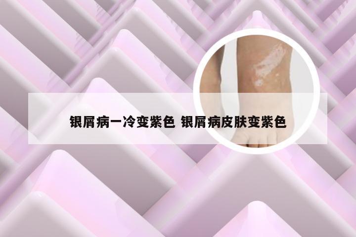 银屑病一冷变紫色 银屑病皮肤变紫色