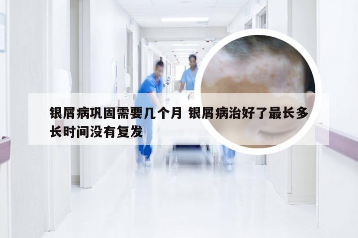 银屑病巩固需要几个月 银屑病治好了最长多长时间没有复发
