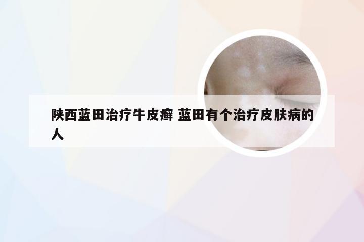 陕西蓝田治疗牛皮癣 蓝田有个治疗皮肤病的人