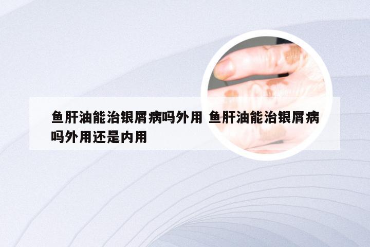 鱼肝油能治银屑病吗外用 鱼肝油能治银屑病吗外用还是内用