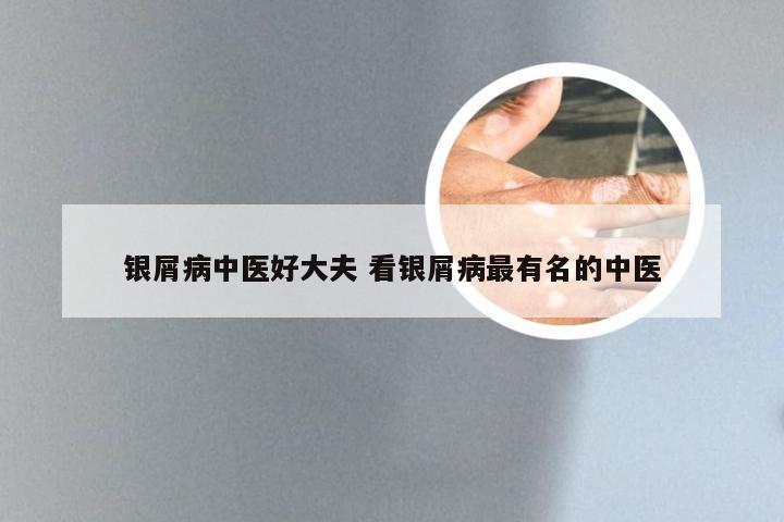 银屑病中医好大夫 看银屑病最有名的中医