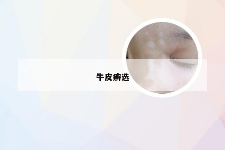 牛皮癣选