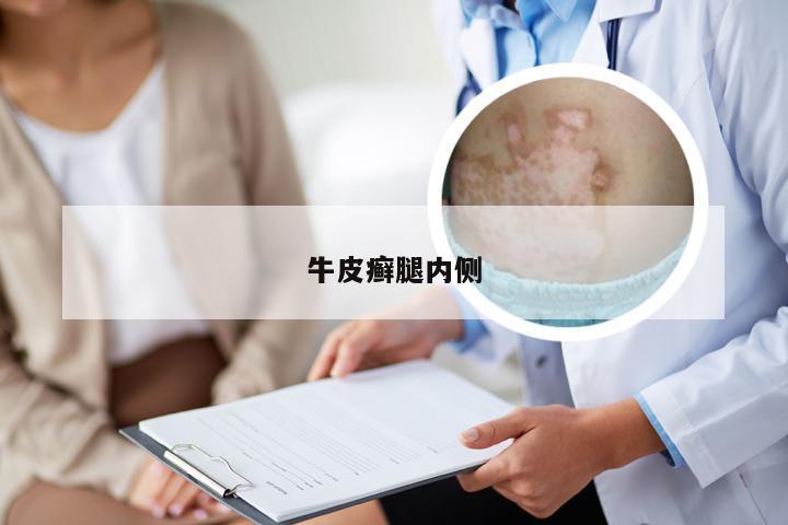 牛皮癣腿内侧