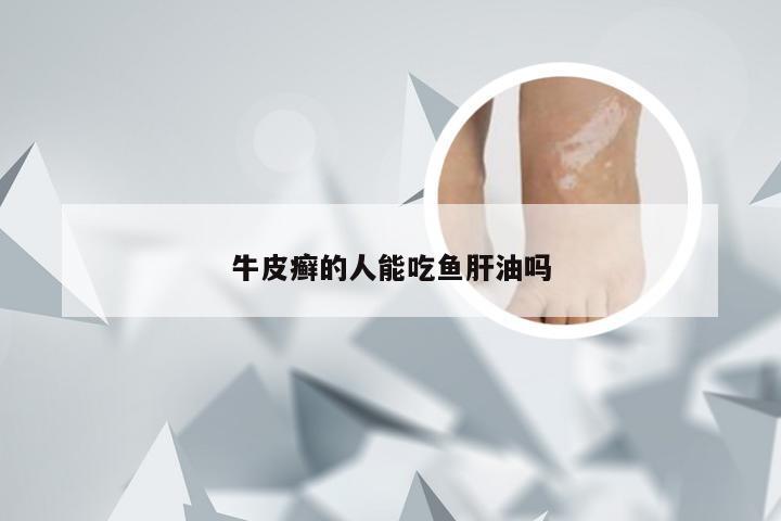 牛皮癣的人能吃鱼肝油吗