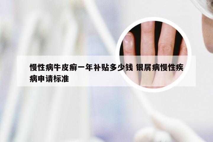 慢性病牛皮癣一年补贴多少钱 银屑病慢性疾病申请标准