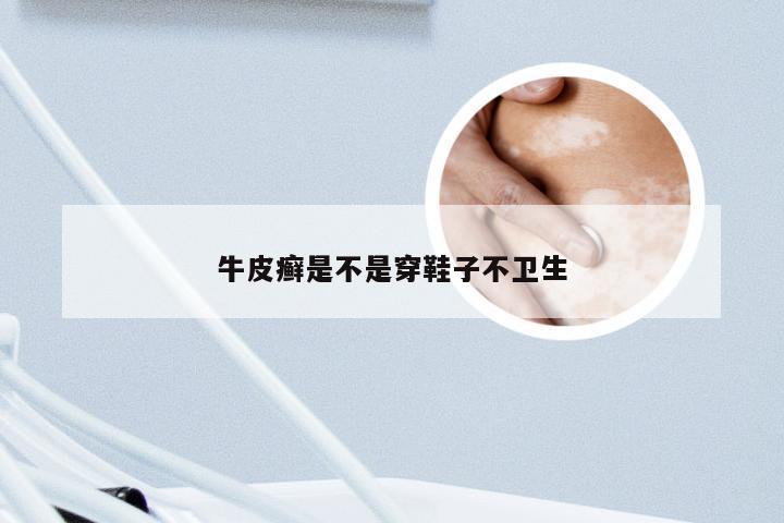 牛皮癣是不是穿鞋子不卫生