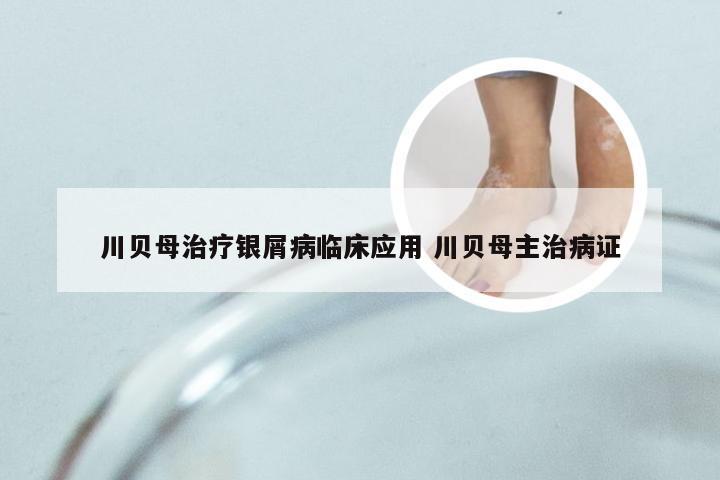 川贝母治疗银屑病临床应用 川贝母主治病证