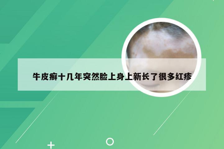 牛皮癣十几年突然脸上身上新长了很多红疹