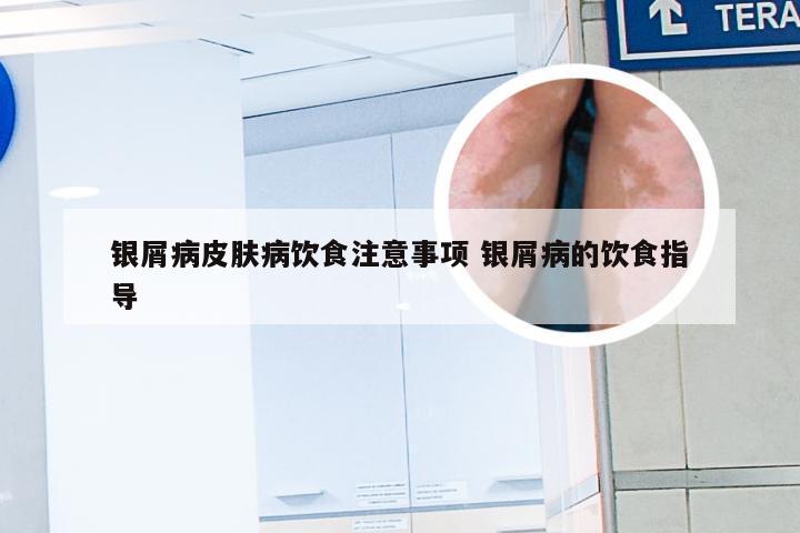 银屑病皮肤病饮食注意事项 银屑病的饮食指导