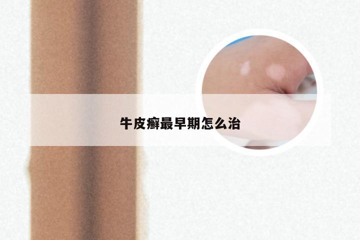 牛皮癣最早期怎么治