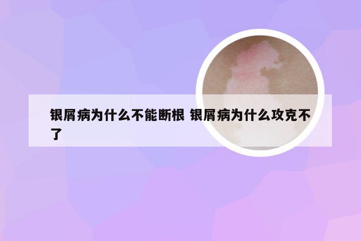 银屑病为什么不能断根 银屑病为什么攻克不了