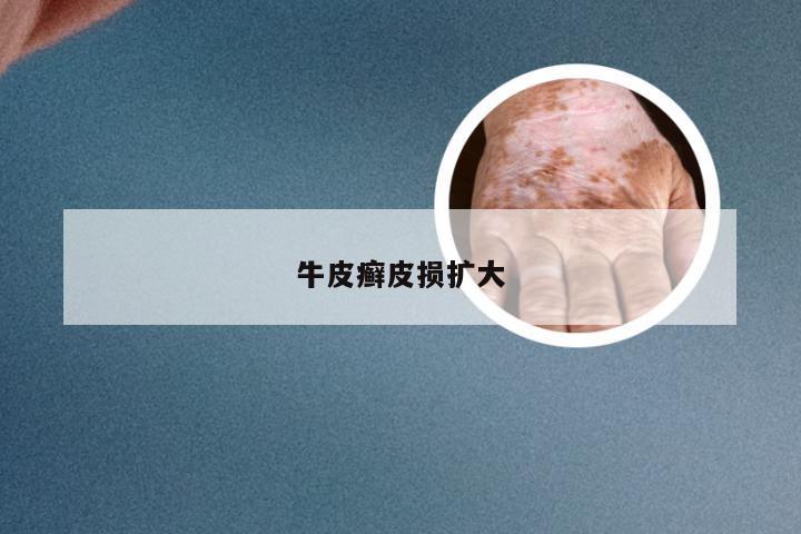 牛皮癣皮损扩大