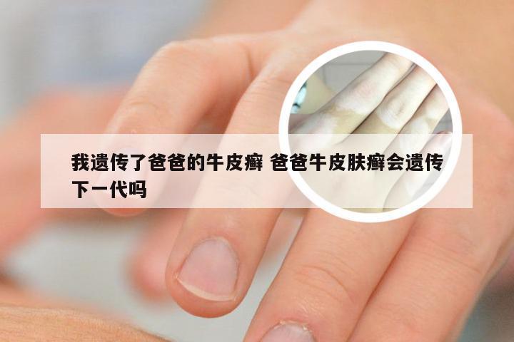我遗传了爸爸的牛皮癣 爸爸牛皮肤癣会遗传下一代吗