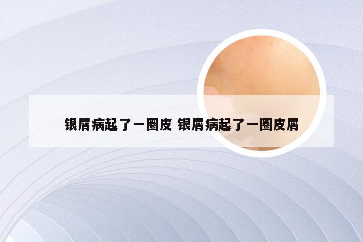 银屑病起了一圈皮 银屑病起了一圈皮屑