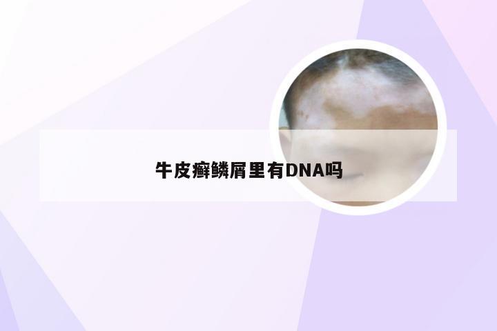 牛皮癣鳞屑里有DNA吗