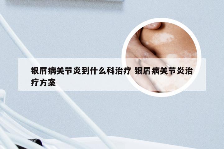 银屑病关节炎到什么科治疗 银屑病关节炎治疗方案