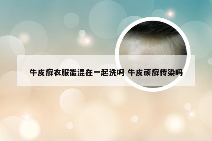 牛皮癣衣服能混在一起洗吗 牛皮顽癣传染吗