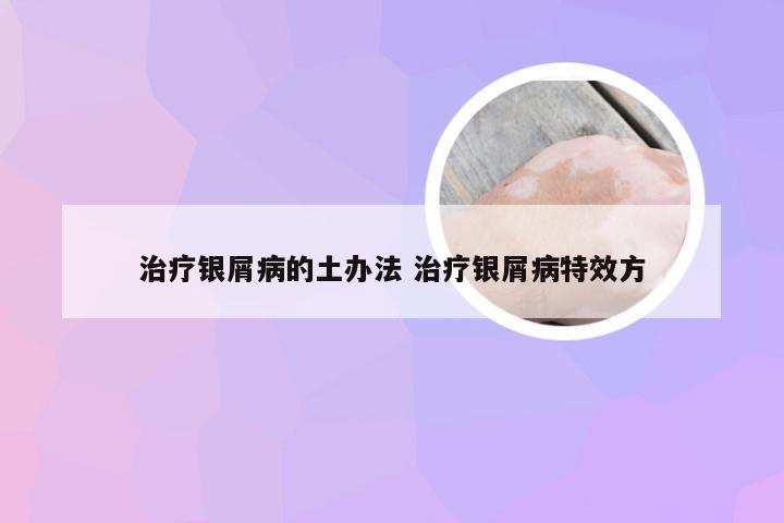 治疗银屑病的土办法 治疗银屑病特效方