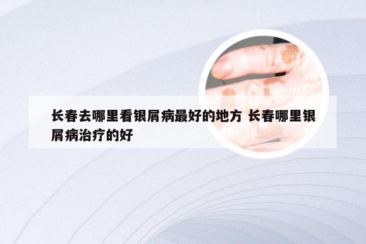 长春去哪里看银屑病最好的地方 长春哪里银屑病治疗的好